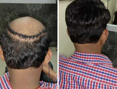 Non Surgical Hair Replacement Service